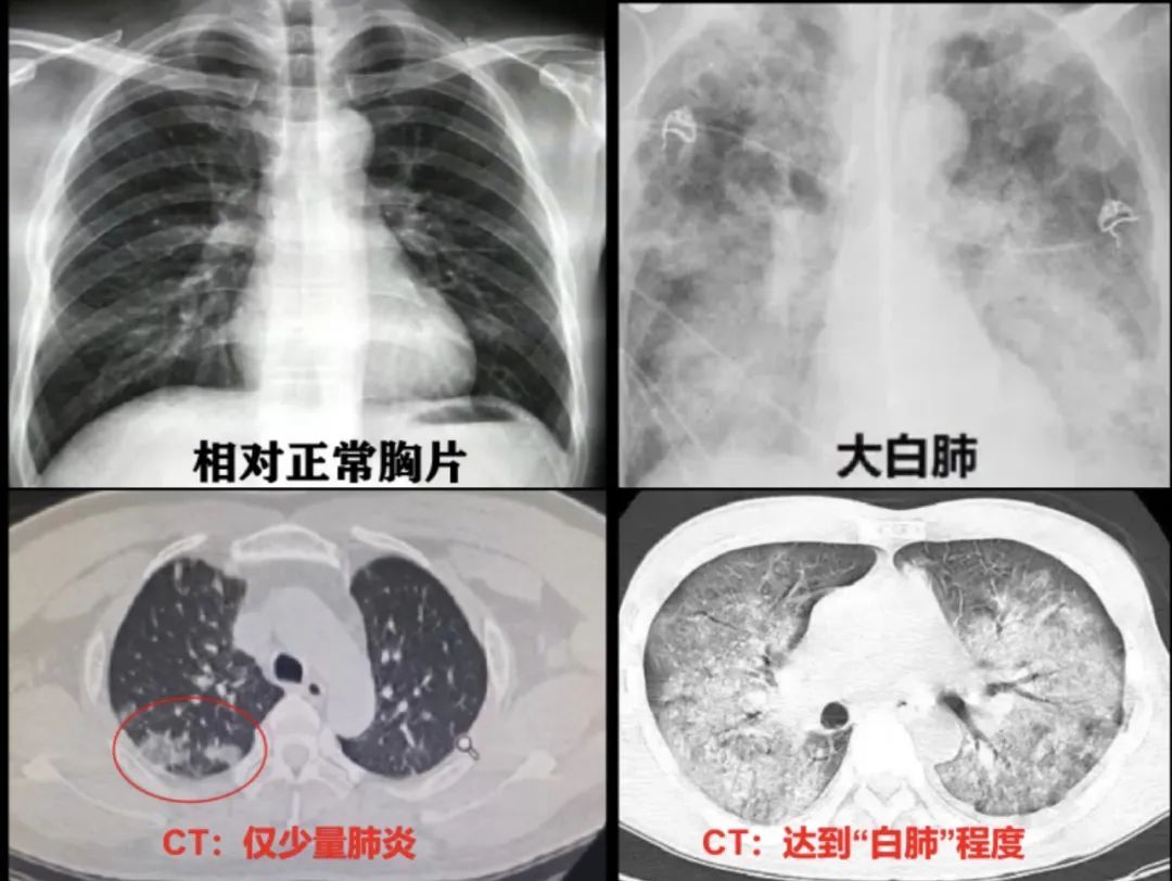 ct影像出现白色就是白肺?重型肺炎预警信号有哪些?