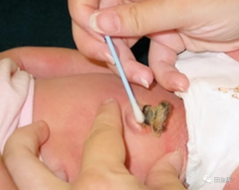 为什么剪脐带要先夹住【孕校素材】新生儿出生后抓住剪子不松手，被抢走后放声大哭，剪脐带会痛吗？_https://www.jmylbn.com_新闻资讯_第9张