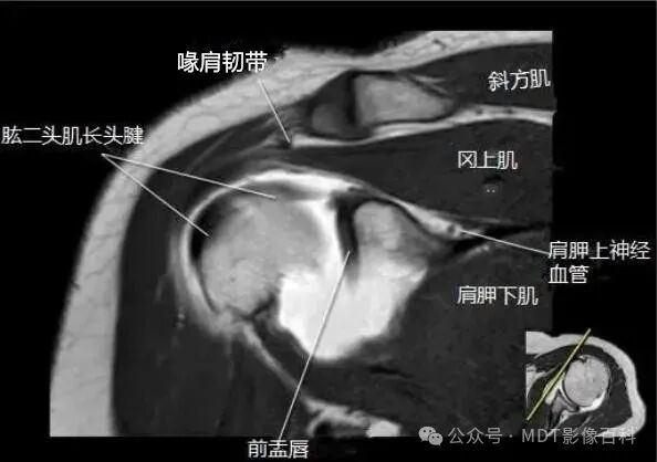 肩关节磁共振（MRI）经典解剖