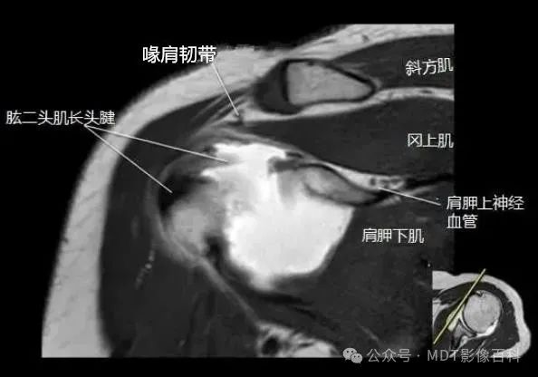 肩关节磁共振（MRI）经典解剖
