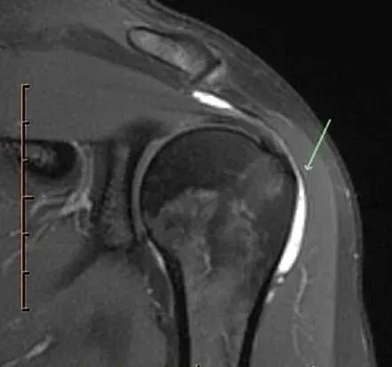 肩关节磁共振（MRI）经典解剖