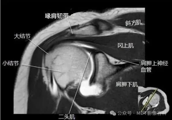 肩关节磁共振（MRI）经典解剖