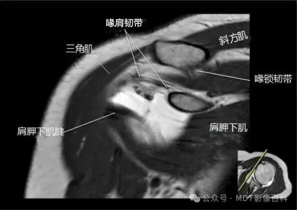 肩关节磁共振（MRI）经典解剖