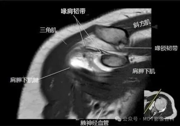 肩关节磁共振（MRI）经典解剖