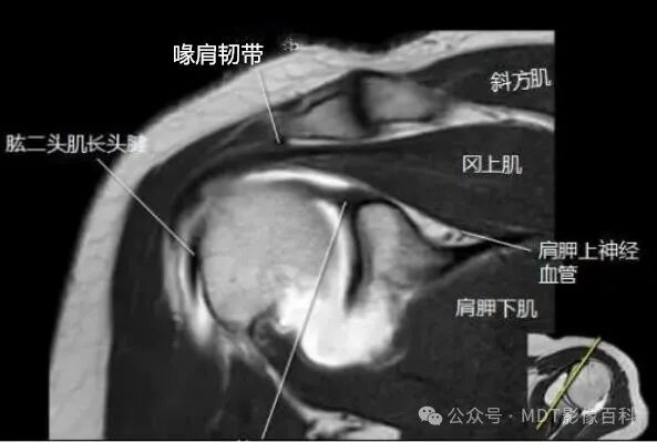 肩关节磁共振（MRI）经典解剖