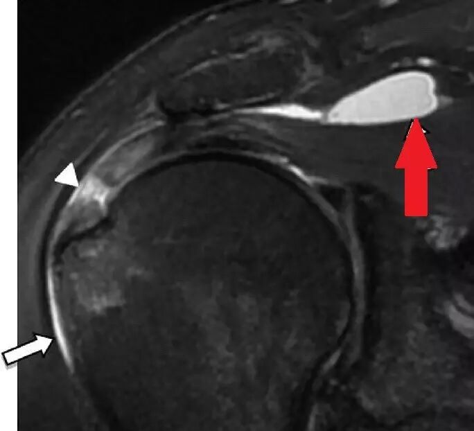 肩关节磁共振（MRI）经典解剖