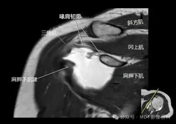 肩关节磁共振（MRI）经典解剖