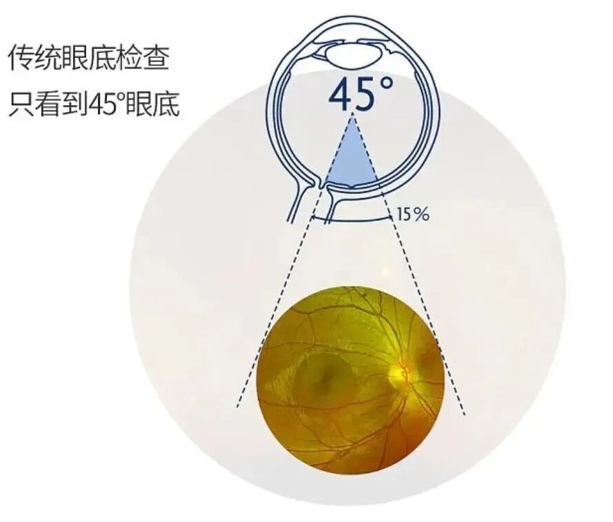 眼底激光机有什么牌子眼底检查“神器”！免扩瞳、0.4秒完成眼底照相，等你体验~_https://www.jmylbn.com_新闻资讯_第16张