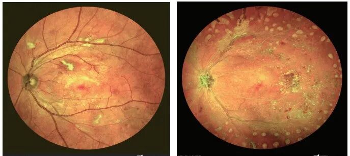 眼底照相有什么用眼底拍张照，眼病早知道！你的眼睛需要拍照吗？_https://www.jmylbn.com_新闻资讯_第8张