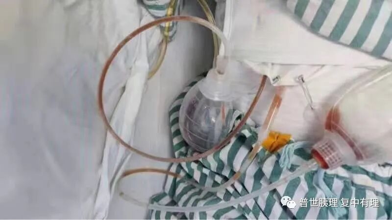 为什么要放负压球胰腺外科常见引流管的注意事项，您都知晓了吗？_https://www.jmylbn.com_新闻资讯_第4张