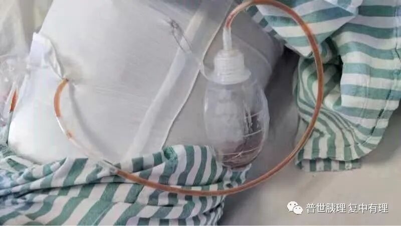 为什么要放负压球胰腺外科常见引流管的注意事项，您都知晓了吗？_https://www.jmylbn.com_新闻资讯_第3张
