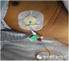 为什么要放负压球胰腺外科常见引流管的注意事项，您都知晓了吗？_https://www.jmylbn.com_新闻资讯_第5张