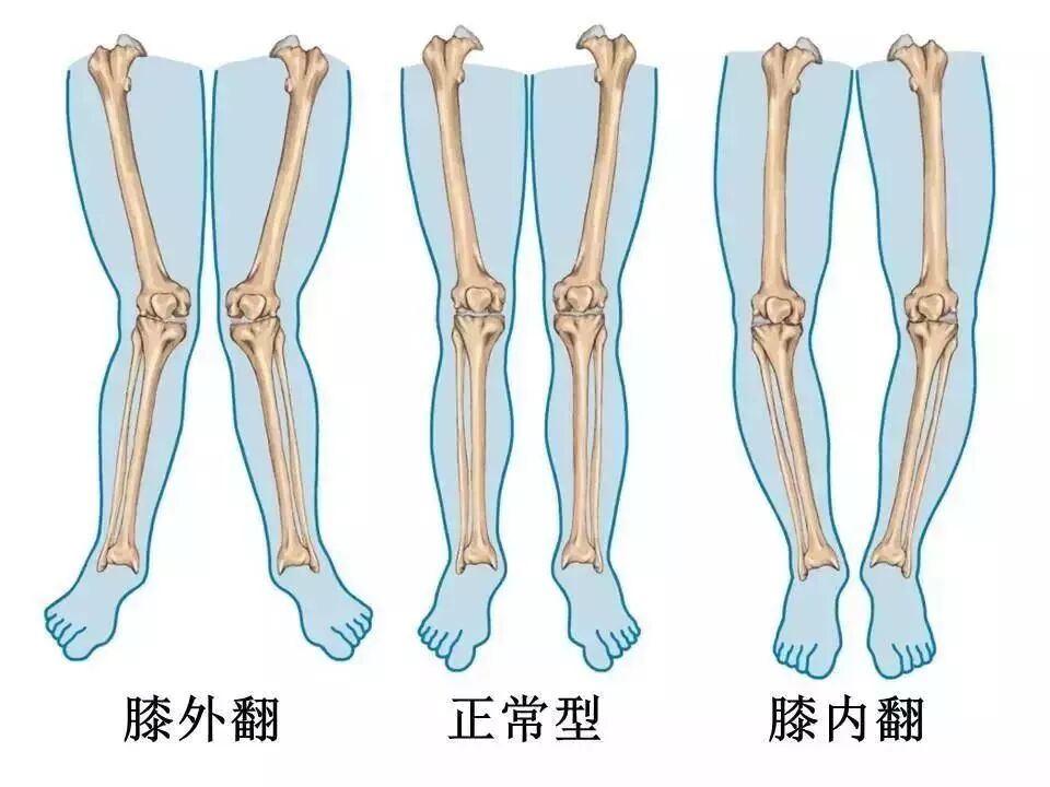 O型腿与X型腿矫正方法全解析：科学治疗策略助你改善腿型问题