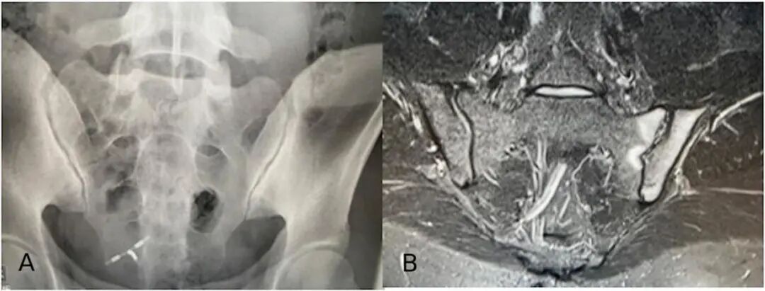 一文读懂中轴型脊柱关节炎的流行病学、诊断与治疗