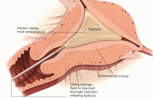 子宫球囊支架怎么取宫腔镜术后放置球囊的用处_https://www.jmylbn.com_新闻资讯_第3张