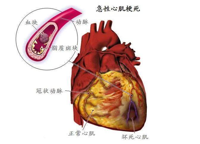 塞球囊怎么取快讯!我院成功完成首例冠状动脉闭塞球囊扩张并支架植入术!_新闻资讯_第7张_活检穿刺产品网 塞球囊怎么取快讯!我院成功完成首例冠状动脉闭塞球囊扩张并支架植入术!_https://www.jmylbn.com_新闻资讯_第7张
