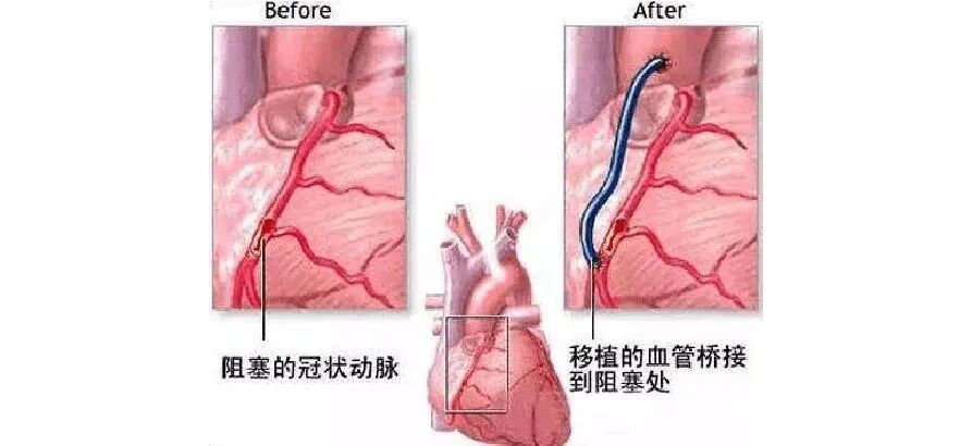 塞球囊怎么取快讯！我院成功完成首例冠状动脉闭塞球囊扩张并支架植入术！_https://www.jmylbn.com_新闻资讯_第5张