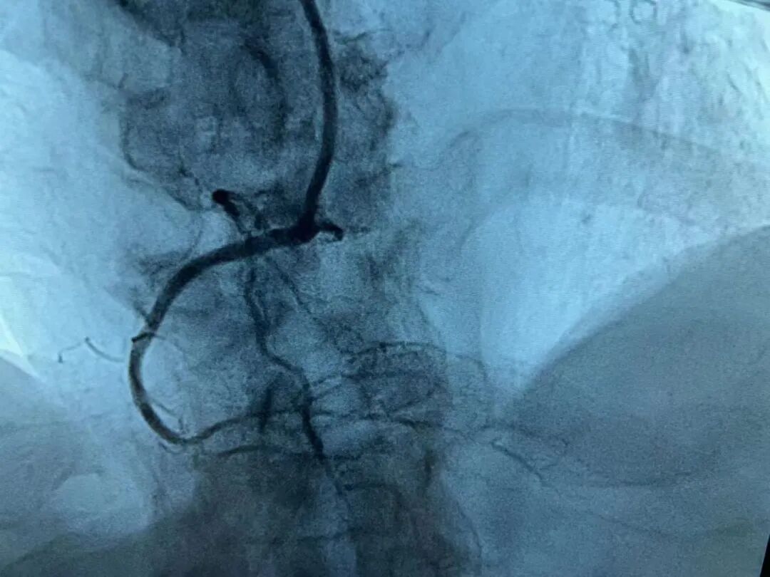 塞球囊怎么取快讯！我院成功完成首例冠状动脉闭塞球囊扩张并支架植入术！_https://www.jmylbn.com_新闻资讯_第11张