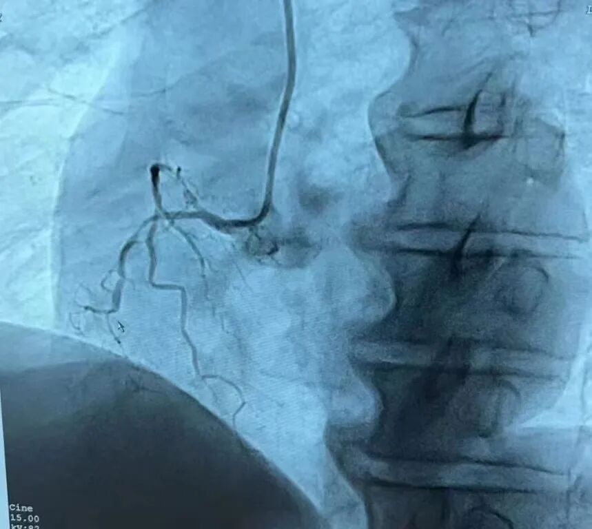 塞球囊怎么取快讯！我院成功完成首例冠状动脉闭塞球囊扩张并支架植入术！_https://www.jmylbn.com_新闻资讯_第10张