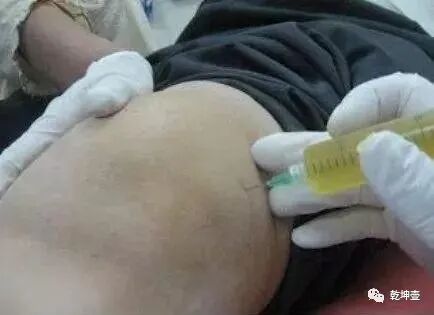 滑膜炎别光吃药抽积液，记住4个原则，关节疼痛消，走路健步如飞