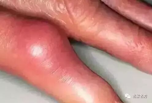 最全“食物嘌呤表”，会吃的人不担心尿酸高，喝黑茶的人避免得痛