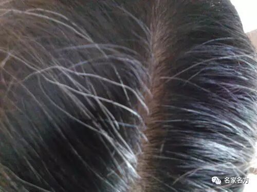 万万没想到，白发长在这里最危险！这几招，教你白发变黑！