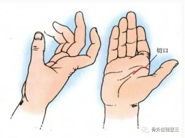 罕见病：掌指关节绞索