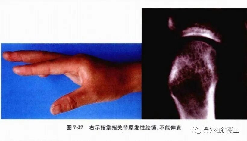 罕见病：掌指关节绞索