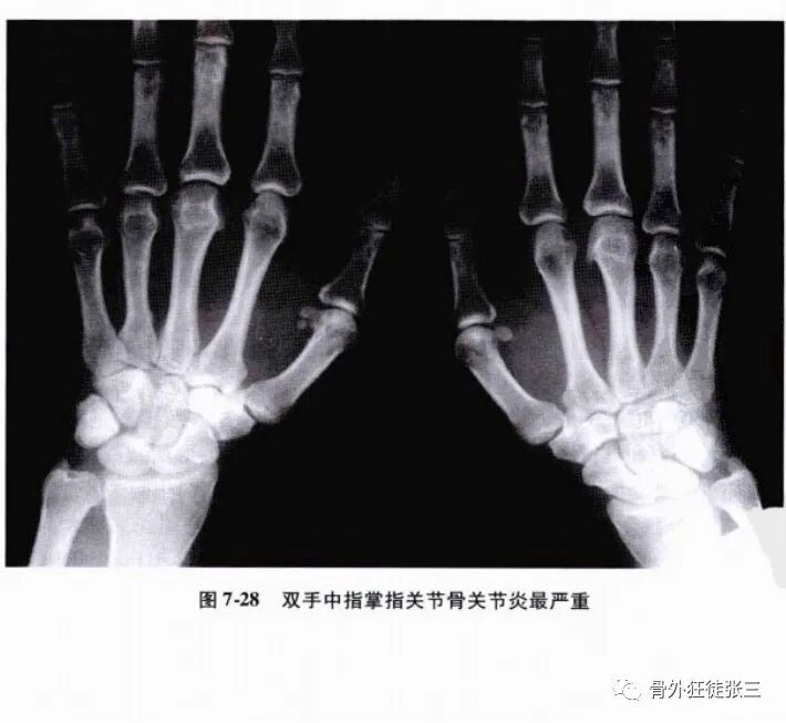 罕见病：掌指关节绞索