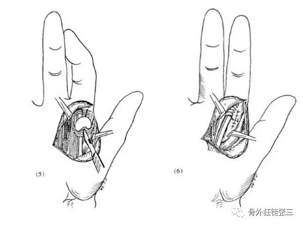 罕见病：掌指关节绞索