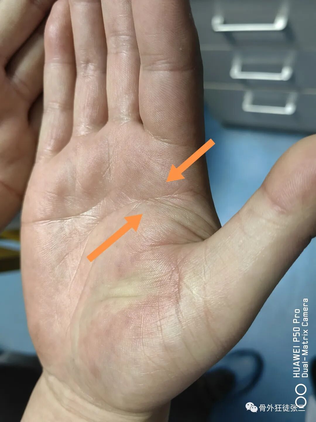 罕见病：掌指关节绞索