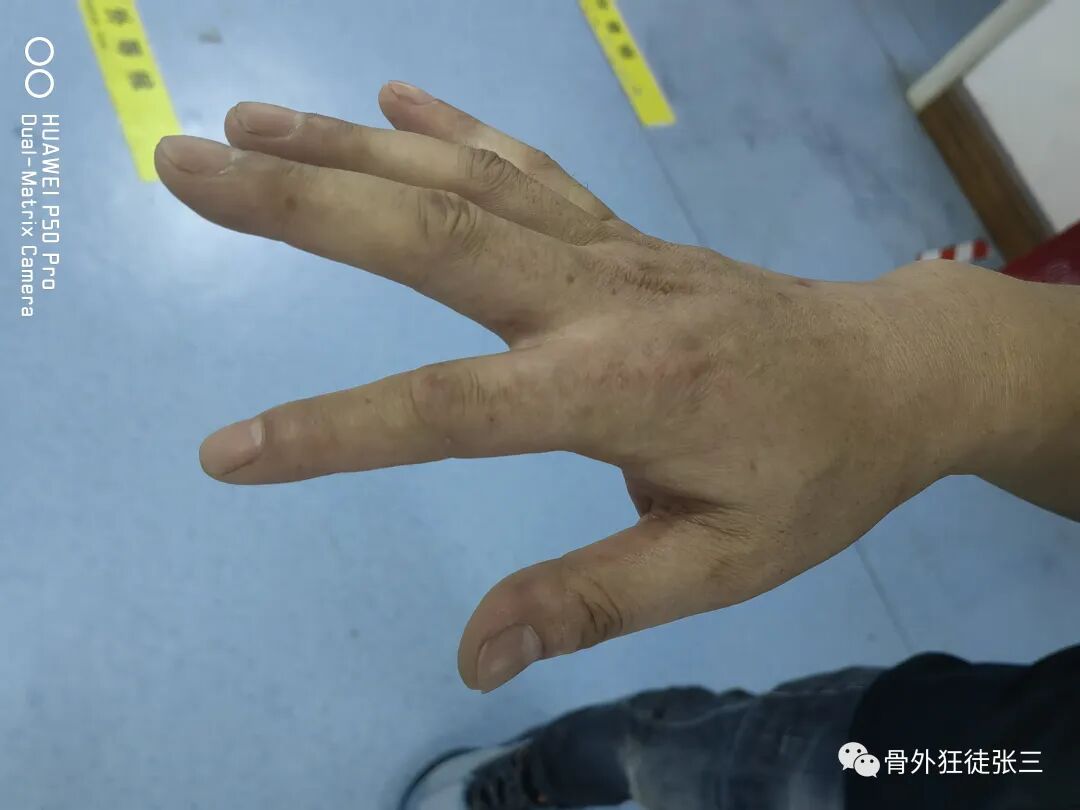 罕见病：掌指关节绞索