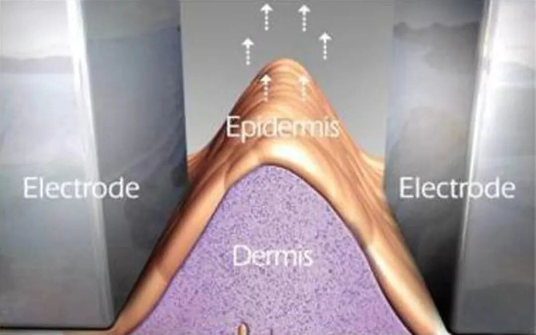 双极刀怎么画前沿速递 ｜ 逆龄黑科技，以色列威拉刀多功能仪器是你的菜吗？_https://www.jmylbn.com_新闻资讯_第5张