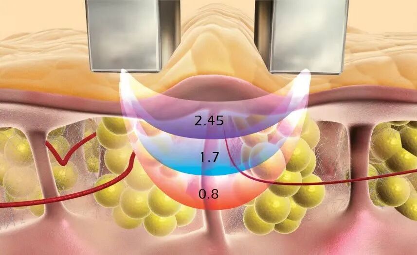 双极刀怎么画前沿速递 ｜ 逆龄黑科技，以色列威拉刀多功能仪器是你的菜吗？_https://www.jmylbn.com_新闻资讯_第3张