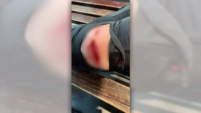 墨尔本女店员路过购物中心被两名女孩抢劫，腿部受伤缝13针！ - 4