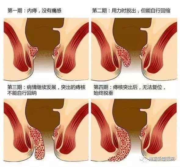 痔疮套扎吻合器怎么用【新康新闻】告别痔疮  健康首选——淮南新康医院成功开展世界领先技术“痔疮套扎吻合术”（RPH-4）_https://www.jmylbn.com_新闻资讯_第2张