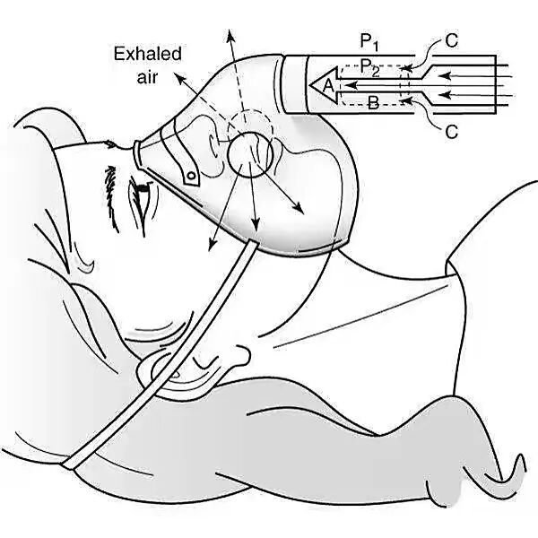 医用吸氧面罩怎么选【医学科普】常见的吸氧面罩_https://www.jmylbn.com_新闻资讯_第14张