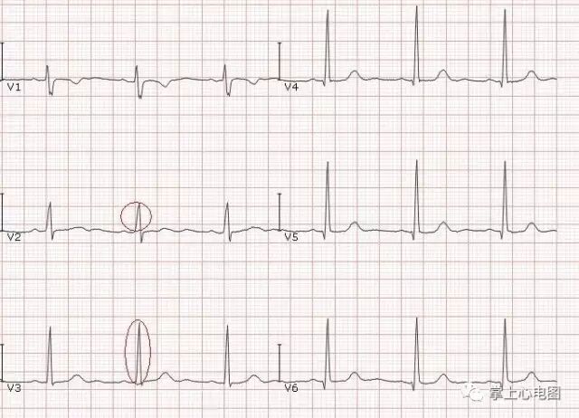 ​qrs 电轴与转位