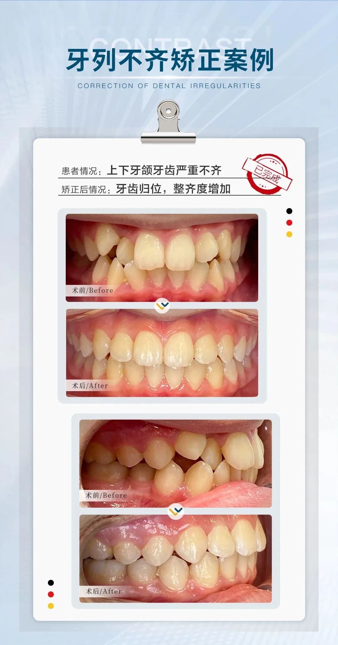 真实案例展示：牙齿矫正后那些令人惊叹的颜值变化！(图22)