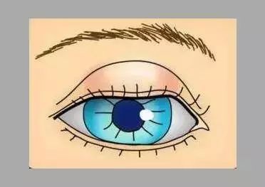 眼瞼上有硬節，你可能得了霰粒腫