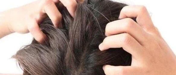 头皮上抠出来的“白泥”到底是啥？看完我直呼好家伙！