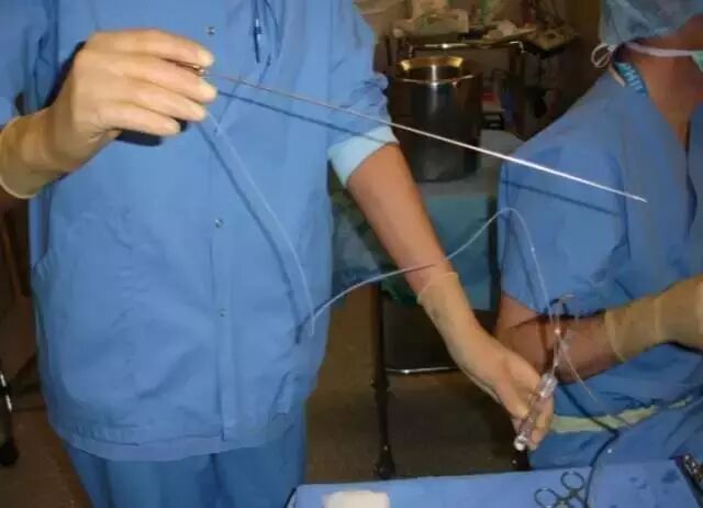 取卵针长什么样取卵的真相_https://www.jmylbn.com_新闻资讯_第6张