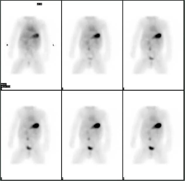 d-spect怎么检查【健康知识】SPECT／CT检查——异位胃黏膜显像_https://www.jmylbn.com_新闻资讯_第5张