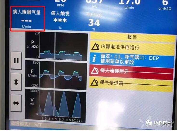 呼吸机f指什么呼吸机名词解释（三）_https://www.jmylbn.com_新闻资讯_第48张