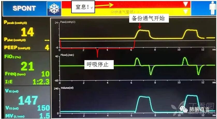 呼吸机f指什么呼吸机名词解释（三）_https://www.jmylbn.com_新闻资讯_第43张