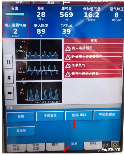 呼吸机f指什么呼吸机名词解释（三）_https://www.jmylbn.com_新闻资讯_第45张