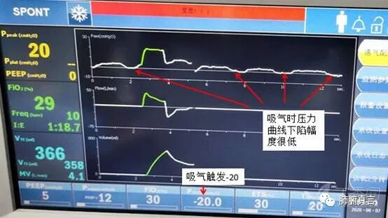 呼吸机f指什么呼吸机名词解释（三）_https://www.jmylbn.com_新闻资讯_第35张