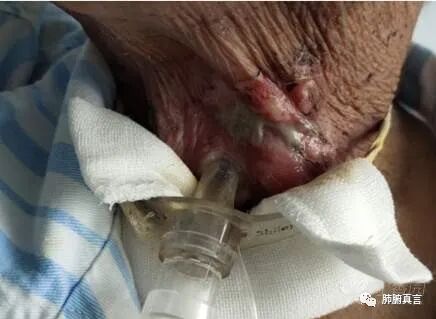 呼吸机f指什么呼吸机名词解释（三）_https://www.jmylbn.com_新闻资讯_第39张