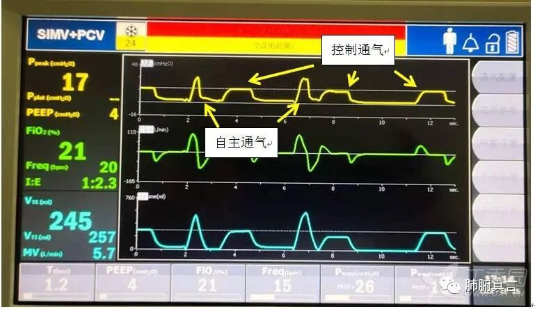 呼吸机f指什么呼吸机名词解释（三）_https://www.jmylbn.com_新闻资讯_第40张