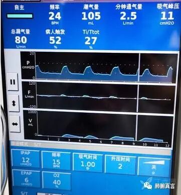 呼吸机f指什么呼吸机名词解释（三）_https://www.jmylbn.com_新闻资讯_第33张